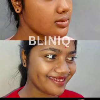 ✨ Natural, Cute Dimples… Now Made Possible!
Here’s a quick before–after glimpse of our Dimple Creati