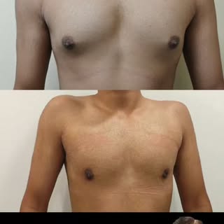 Grade 2A Gynecomastia Transformation | Confidence Restored 💪

Tired of hiding behind loose T-shirts