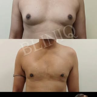 Gynecomastia Grade 2 Results