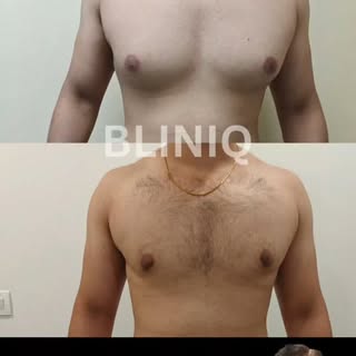 ✨ 3 Months After Gynecomastia Surgery – Confidence Restored! 💪

From hiding behind loose clothes to