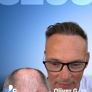 Every case is unique.
For Oliver, that meant 5,200 grafts using the NEO FUE extraction method and DH