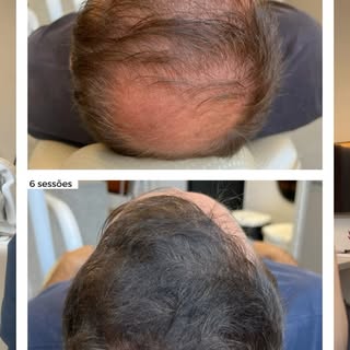 Resultado incrível de um paciente com alopecia androgenética realizando o tratamento capilar previam