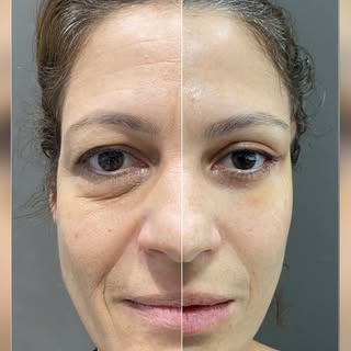 Olha esse resultado 😱

#blefaroplastia #plastica #liftingtemporal #cirurgiaplastica
