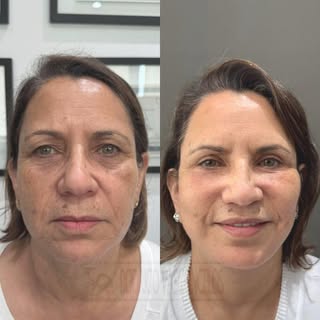 O edema vai sumindo, as cicatrizes se escondendo e o resultado vai aparecendo. A transformação físic