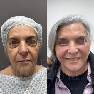15 dias de pós-operatório de um Lifting Facial com Blefaroplastia estruturada e Lip Lift. 

Em pouco