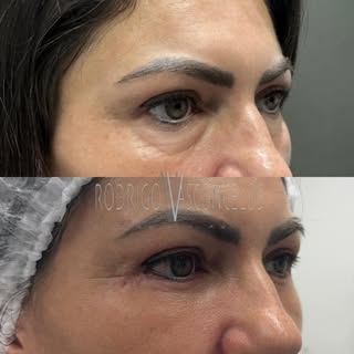 #tbt desse resultado de Blefaroplastia estruturada inferior. 

O que você achou?

Dr. Rodrigo V.Vasc