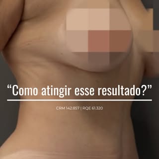 Quer descobrir como alcançamos um resultado como esse? 

Conheça a Abdominoplastia associada à lipoa