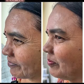 ✨ Achieve smooth, youthful, and naturally refreshed skin with Botox at Derma 360! 💉 Say goodbye to 