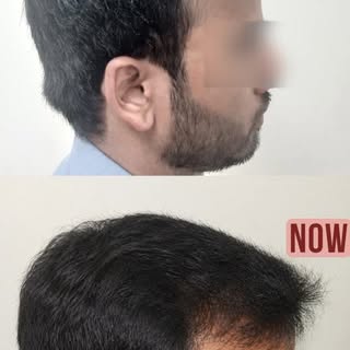 From hair loss to real confidence, the right approach makes all the difference.

Carefully planned, 