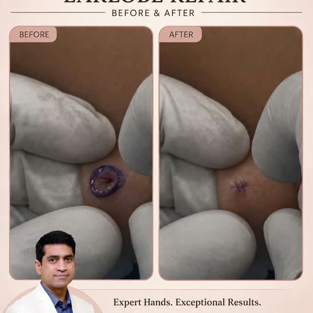 ✨ Confidence is in the details.
A torn or stretched earlobe may seem like a small concern, but resto