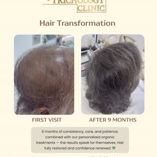 "Hair restoration doesn't happen overnight - it take consistency, care and patience.💆‍♀️🌿✨️
After 