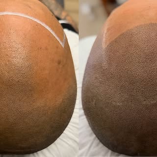 Natural Undetectable Results!

#scalpmicropigmentation #smp #hairtattoo #tattoo #artist #scalptattoo