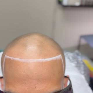 Before and After results of Scalp Micropigmentation!

#scalpmicropigmentation #smp #massachussets #f