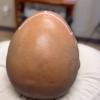 The Best price for Quality results! 

#scalpmicropigmentation #hairloss #smp #hairtattoo #hairtransp