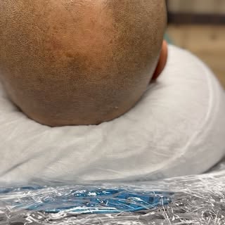 #scalpmicropigmentation #hairloss #smp #hairtattoo #massachussets