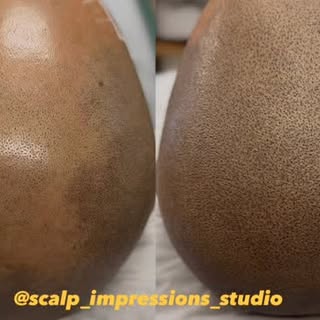 ‼️Get your procedure at an amazing discount of $425 per session for a LIMITED TIME!!!🤯‼️

#smp #hai