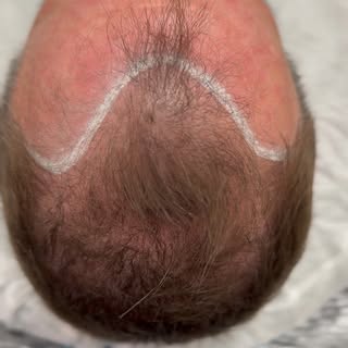 Before and after Scalp Micropigmentation!

#smp #hairloss #thinninghair #newengland #barbershop