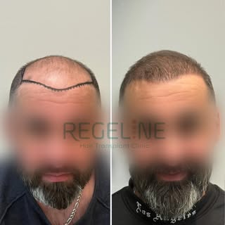 Incredible results in less than 8 months after a hair transplant, achieved with the expertise of our