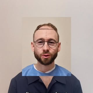 A pleasure to welcome Jesper back for the second part of his hair transplant journey. Seeing such im