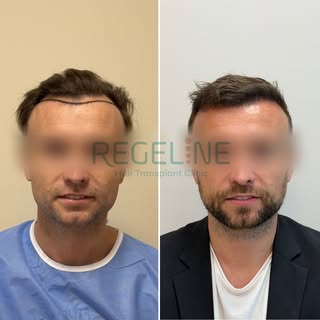 3,500 Grafts. Density Restored. 🙌

Congratulations! These are just the first results after only 6 m
