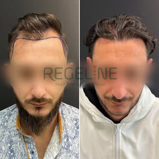 Results that speak for themselves!

Natural hairline. Permanent results.