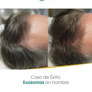 Recupera tu cabello, recupera tu confianza.

¿Te imaginas mirarte al espejo y volver a ver un cabell
