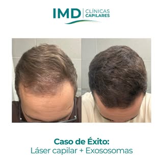 En este caso de éxito podemos ver la evolución real de un paciente tratado con Láser Capilar + Exoso