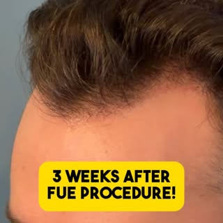 Let’s check in with our FUE patient 3 weeks after his procedure to see how everything is healing! #h