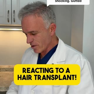 Let’s talk about the results of this hair transplant procedure! If you want a video review of the wo