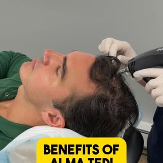 Let’s talk about the benefits of Alma TED treatment! #hairloss #hairlosstreatment