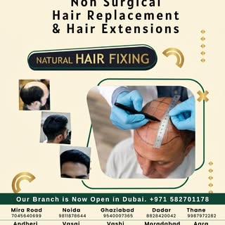 ✨ Hair loss doesn't have to define your story. Take the non-surgical route to fuller, natural-lookin