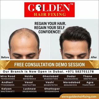Hair loss around the front hairline, temples, or crown could be an early sign of Male Pattern Baldne