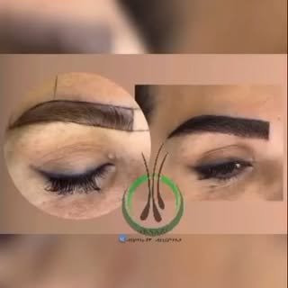 کاشت ابرو با روش FUT
جدید ترین و بهترین روش کاشت ابرو پر تراکم با خواب طبیعی... 
ابرو یکی از مهمترین