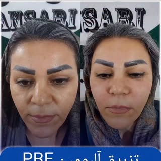 تزریق ( آلبومینPRF ) 🌱

✅ جوانسازی طبیعی با خون خود فرد
✅ افزایش حجم ملایم و طبیعی
✅ بهبود قوام و ش