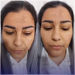 ✨ جوانسازی طبیعی با درمان های زیست محور✨

جوانسازی طبیعی با استفاده از پلاسمای غنی از پلاکت بدن خود 