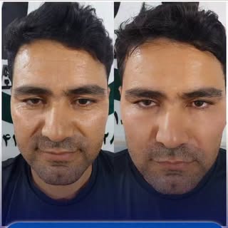💥جوانسازی طبیعی با تزریق ( آلبومین PRF ) 💥
✅ جوانسازی کاملا طبیعی با خون خود فرد
✅ از بین بردن خط 