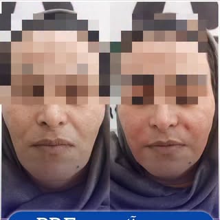 ❗️اگه می‌خوای خط لبخندت ترمیم بشه
❗️اگه زاویه صورتت واضح‌تر و شیک‌تر بشه
❗️اما نمی‌خوای ژل بزنی و چه