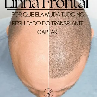 Linha frontal muda tudo no transplante capilar ✨

É ela que define se o resultado será natural ou ar