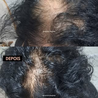 Paciente em tratamento de alopecia androgenética, popularmente conhecida como CALVÍCIE. 

Apesar de 