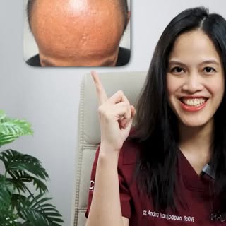 Progress 3 bulan salah satu pasin kami yang sudah melakukan hair transplant..

Pelan namun pasti ya 