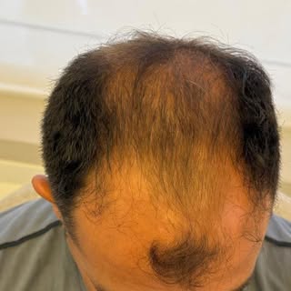A queda de cabelo pode impactar muito mais do que a aparência. Para muitos homens, ela também influe