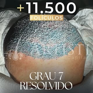 Essa não é uma cirurgia comum.
Estamos falando de um caso grau 7, o nível mais avançado de calvície.