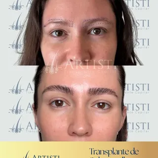 7 meses de evolução e um resultado que respeita cada detalhe da anatomia da sobrancelha. ✨

Neste ca
