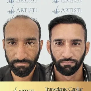9 meses de evolução e uma mudança que vai além do preenchimento das falhas 👇

A reconstrução da lin