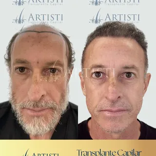 Cada resultado conta uma história. E esta começou com anos convivendo com a calvície e terminou com 