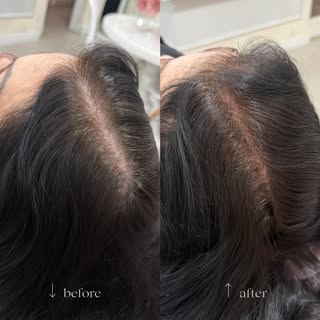 A queda de cabelo acentuada assusta e mexe profundamente com a autoestima feminina. Mas a boa notíci