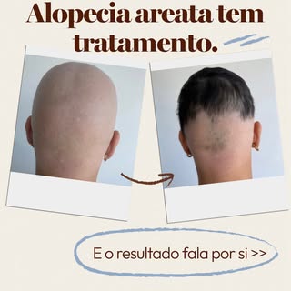 A melhora não significa que a alopecia desapareceu. Significa que ela está sendo controlada. É exata