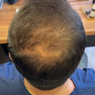 ✨Antes da viagem, o pedido era um só: recuperar o cabelo e voltar a se sentir confiante.

Com um tra