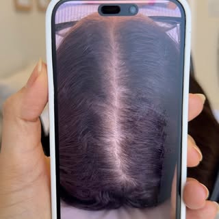 Ela: Antes eu não sabia mais o que fazer. Meu cabelo caía muito e a coceira no couro cabeludo não me