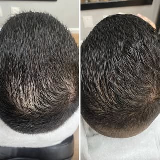 Protocolo para anomalia do couro cabeludo masculino, inclusive a calvície. 

A saúde do couro cabelu